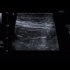 Small bowel obstruction, ileus, Crohn's disease: US - Ultrasound